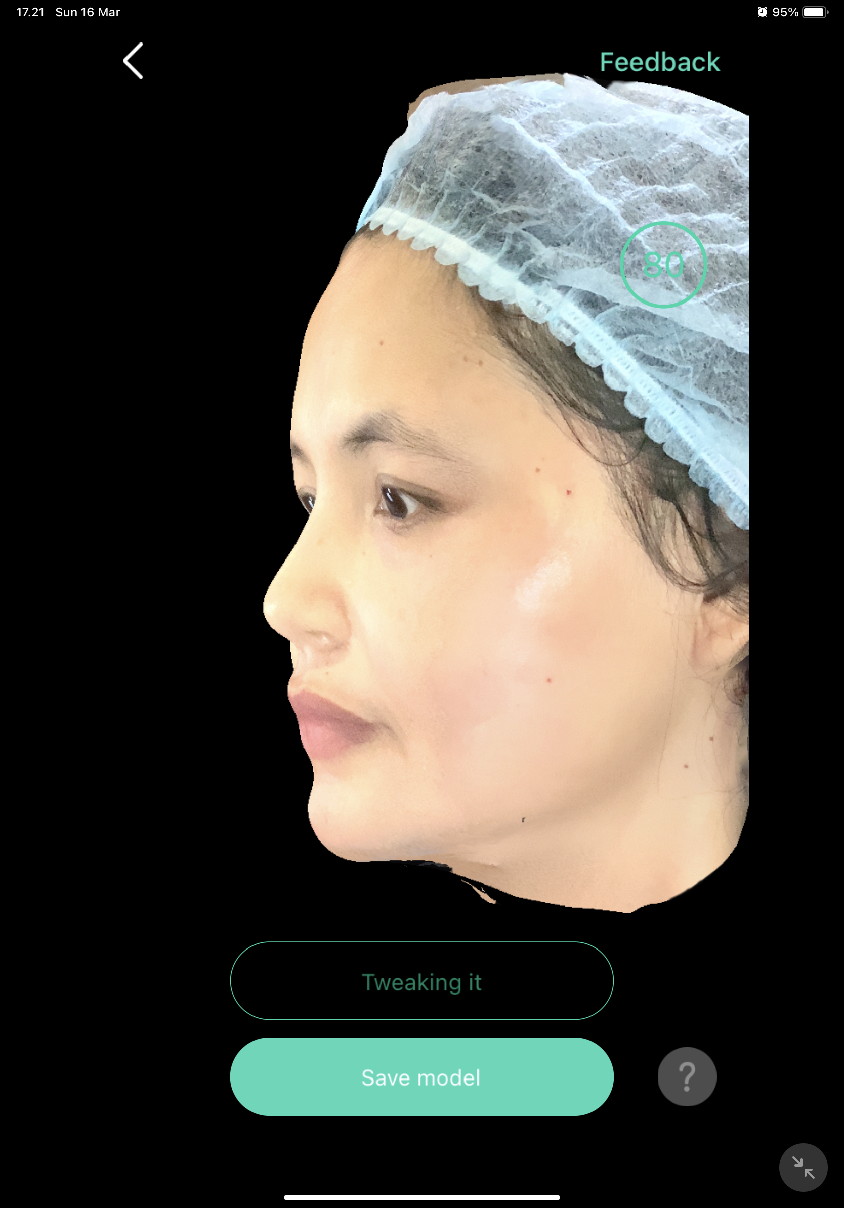 After — Filler Bibir