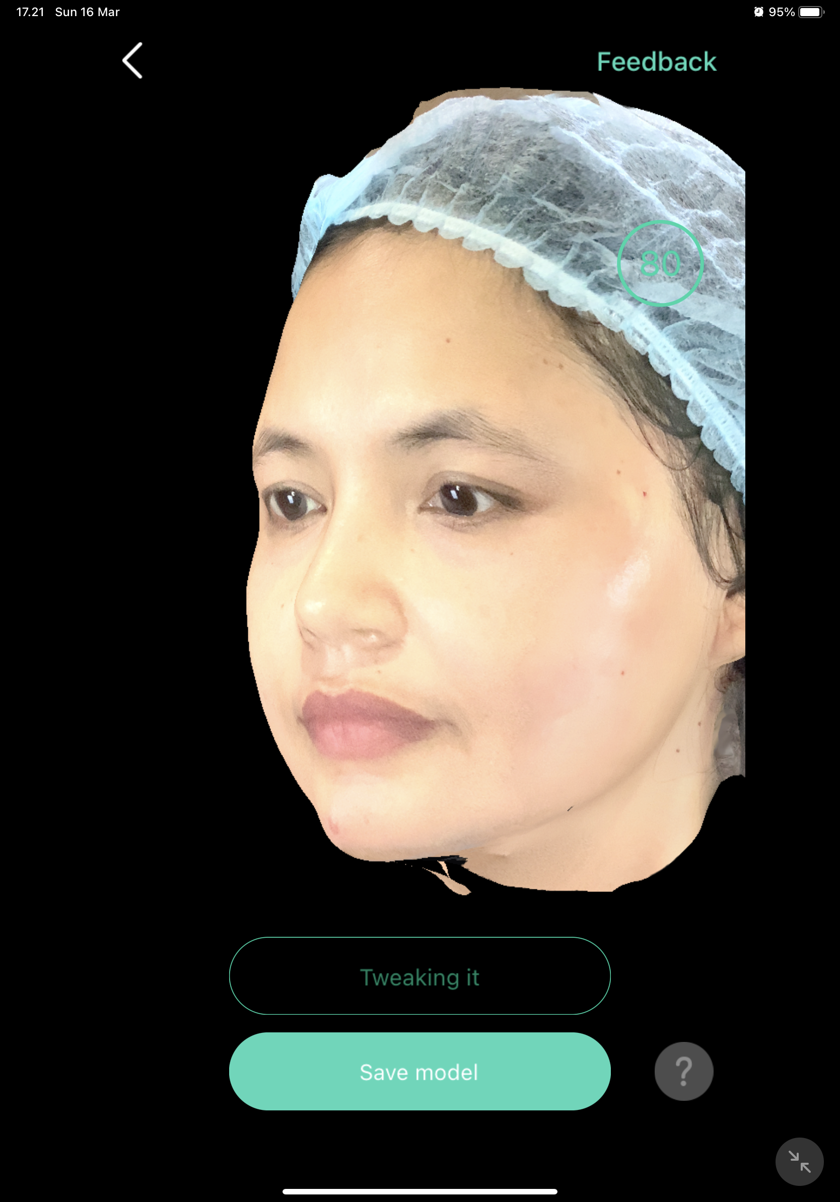 Before — Filler Bibir