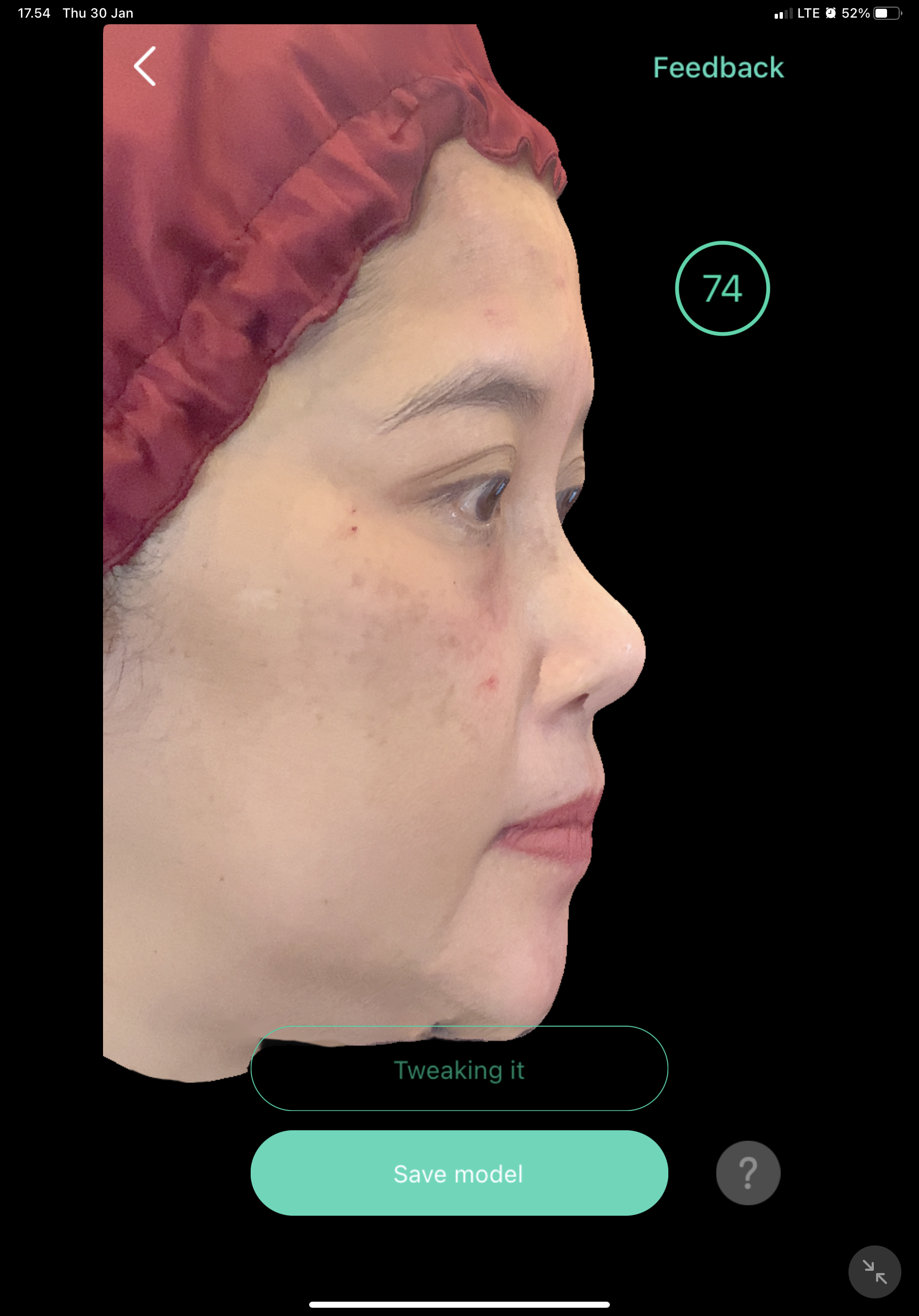 After — Filler Hidung