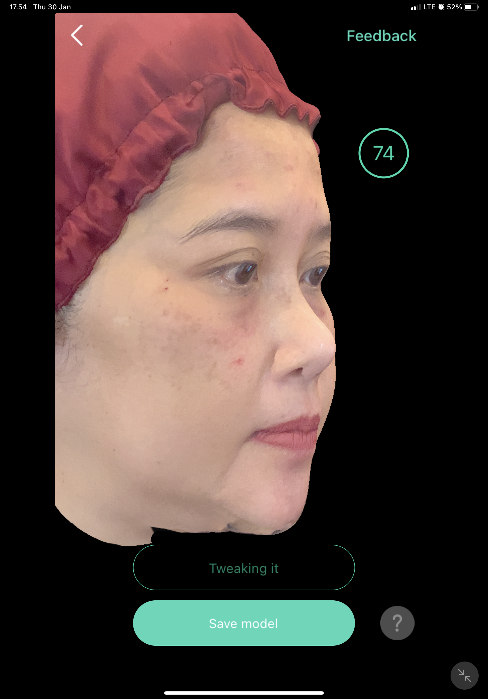 Before — Filler Hidung