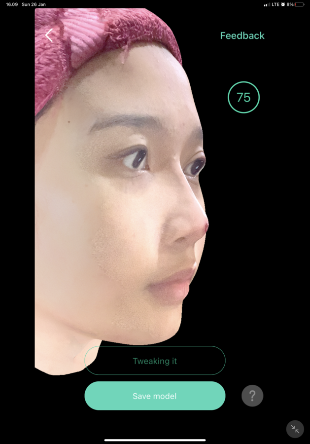 After — Threadlift Hidung