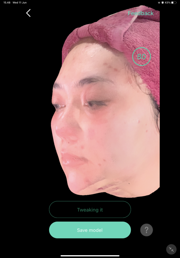 After — Threadlift Pipi