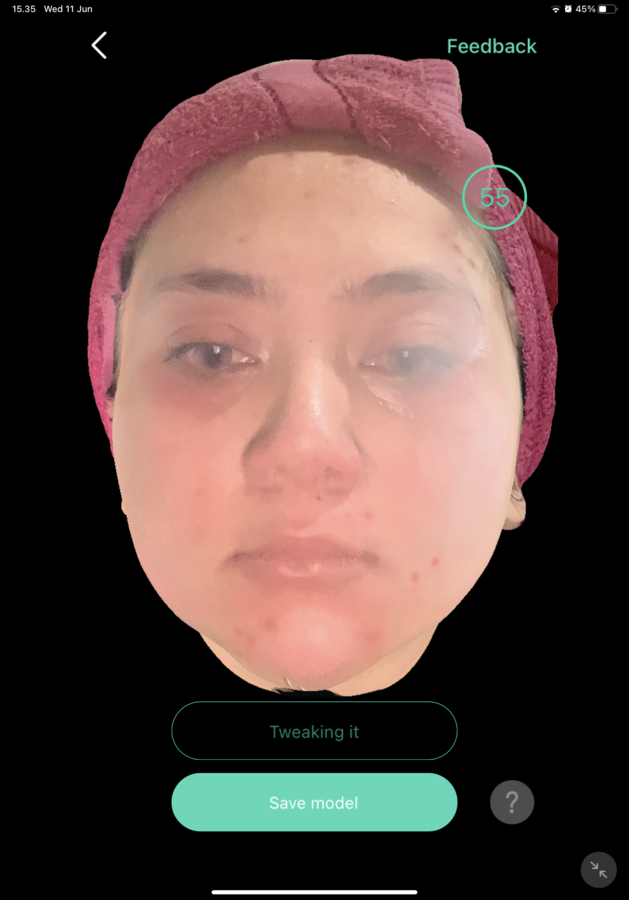 Before — Threadlift Pipi